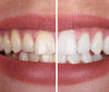 Brightsmile v34™ Dental Color Corrector
